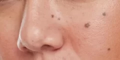 تعبیر خواب خال ابن سیرین و امام صادق + برداشتن خال گوشتی روی صورت و گردن